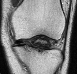 ACL Bony Avulsion Adult